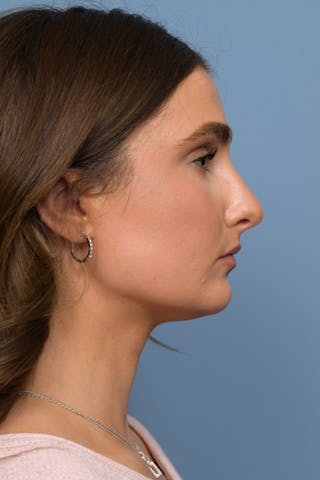Rhinoplasty Before & After Gallery - Patient 236933 - Image 6
