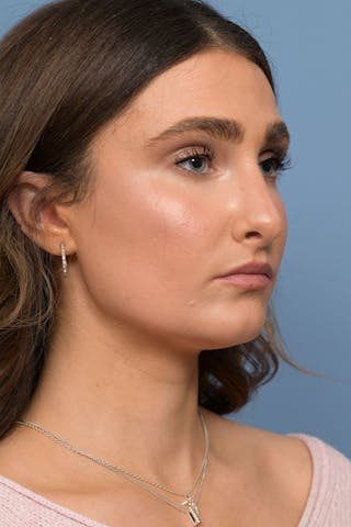 Rhinoplasty Before & After Gallery - Patient 236933 - Image 8