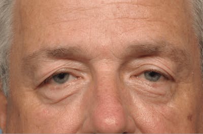 Upper Eyelid Lift Before & After Gallery - Patient 190857 - Image 1