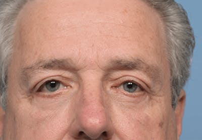 Upper Eyelid Lift Before & After Gallery - Patient 190857 - Image 2
