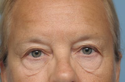 Upper Eyelid Lift Before & After Gallery - Patient 620157 - Image 1