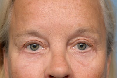 Upper Eyelid Lift Before & After Gallery - Patient 620157 - Image 2