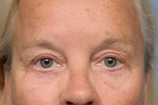 Upper Eyelid Lift Before & After Gallery - Patient 620157 - Image 2