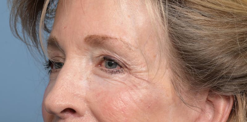 Lower Eyelid Lift Before & After Gallery - Patient 346871 - Image 4