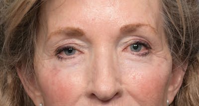 Lower Eyelid Lift Before & After Gallery - Patient 346871 - Image 2