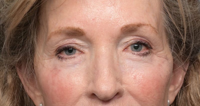 Lower Eyelid Lift Before & After Gallery - Patient 346871 - Image 2