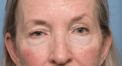 Lower Eyelid Lift Before & After Gallery - Patient 346871 - Image 1