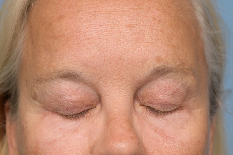 Upper Eyelid Lift Before & After Gallery - Patient 620157 - Image 4