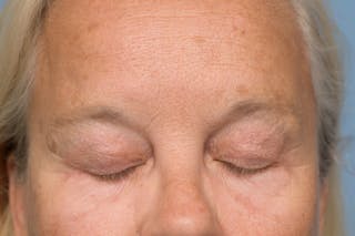Upper Eyelid Lift Before & After Gallery - Patient 620157 - Image 4