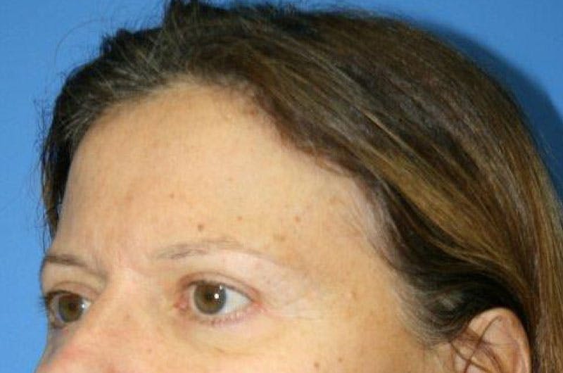 Brow Lift / Forehead Lift Before & After Gallery - Patient 906914 - Image 9