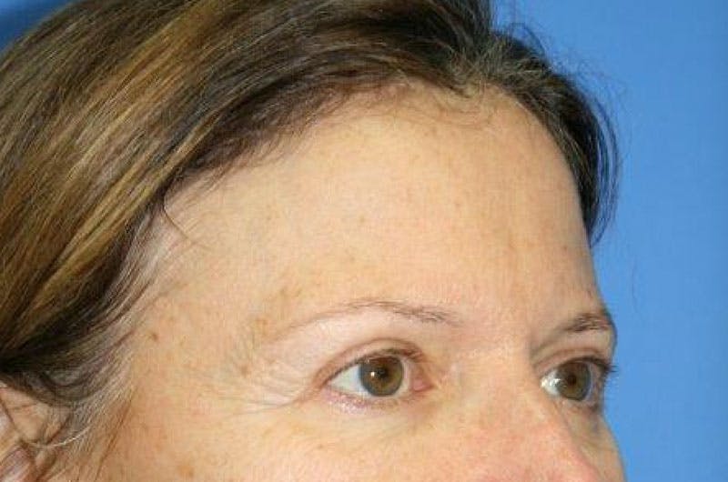 Brow Lift / Forehead Lift Before & After Gallery - Patient 906914 - Image 3