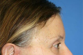Brow Lift / Forehead Lift Before & After Gallery - Patient 906914 - Image 6