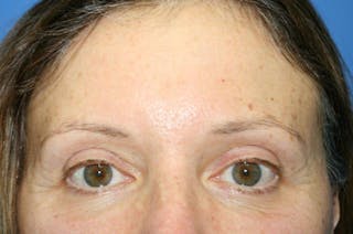 Brow Lift / Forehead Lift Before & After Gallery - Patient 906914 - Image 2