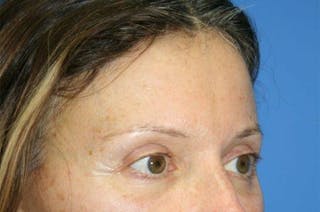 Brow Lift / Forehead Lift Before & After Gallery - Patient 906914 - Image 4
