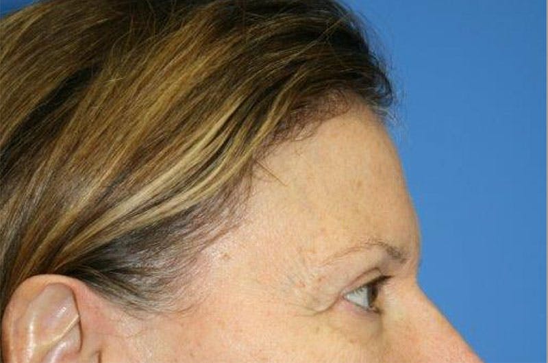 Brow Lift / Forehead Lift Before & After Gallery - Patient 906914 - Image 5