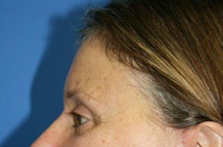 Brow Lift / Forehead Lift Before & After Gallery - Patient 906914 - Image 8
