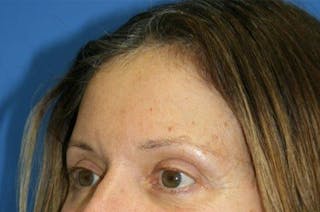 Brow Lift / Forehead Lift Before & After Gallery - Patient 906914 - Image 10