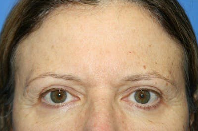 Brow Lift / Forehead Lift Before & After Gallery - Patient 906914 - Image 1