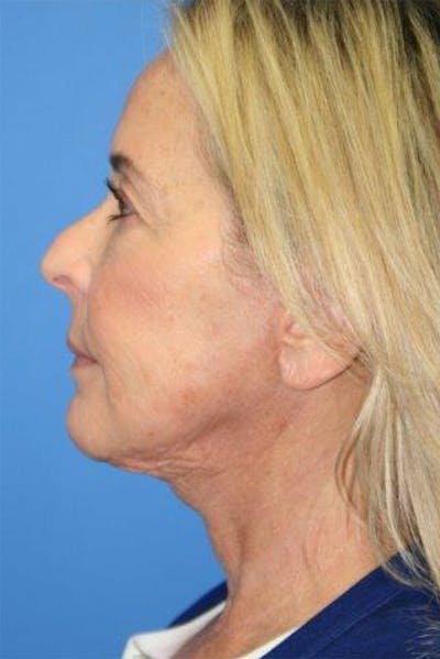 Deep Plane Facelift Before & After Gallery - Patient 240765 - Image 2