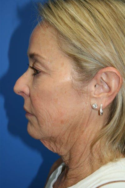 Deep Plane Facelift Before & After Gallery - Patient 240765 - Image 1