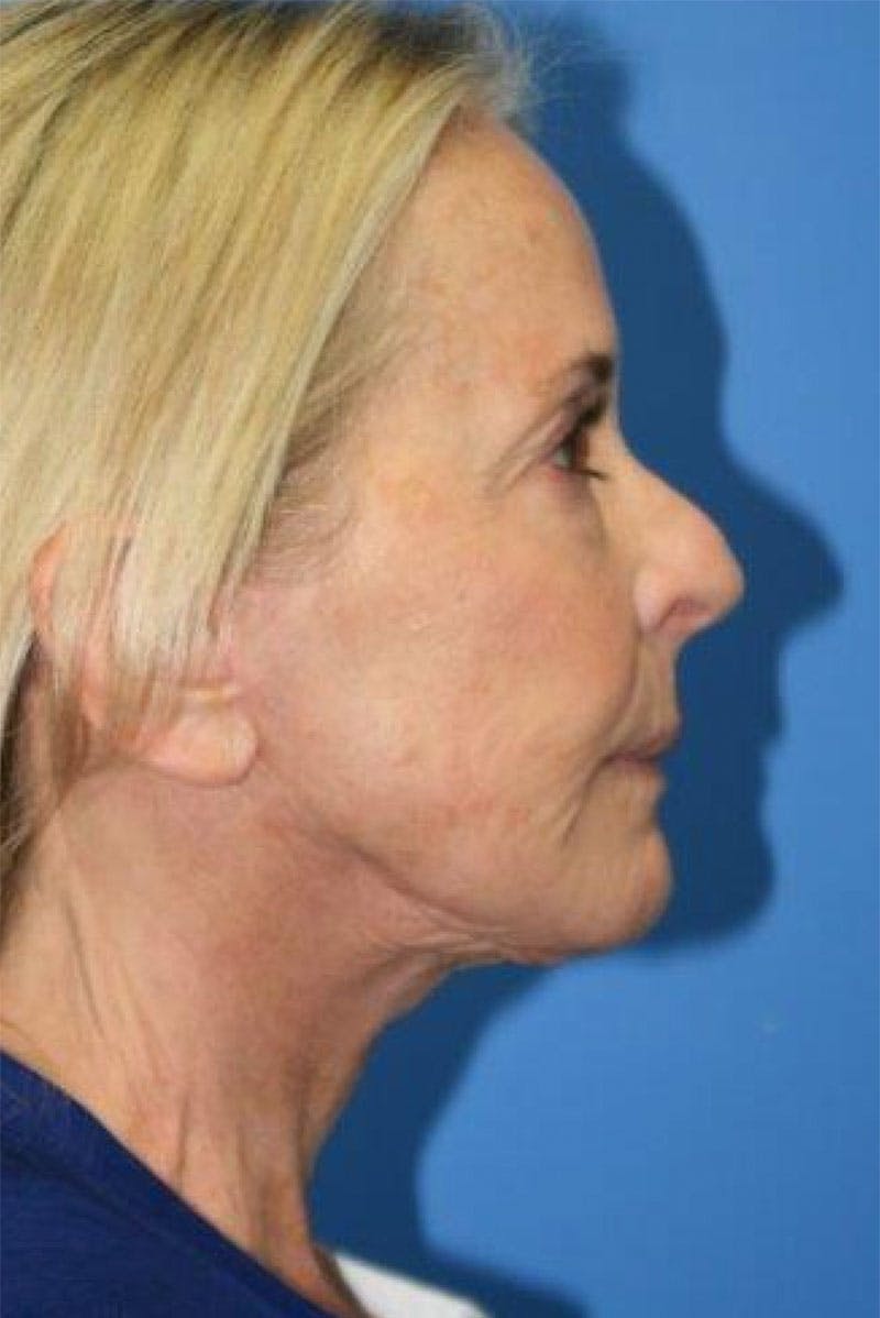 Neck Lift Before & After Gallery - Patient 323201 - Image 4