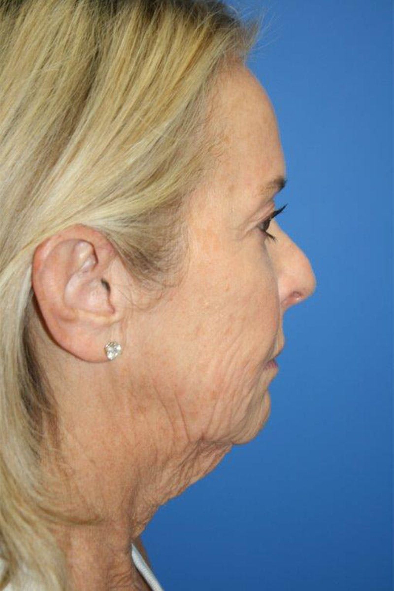 Neck Lift Before & After Gallery - Patient 323201 - Image 3