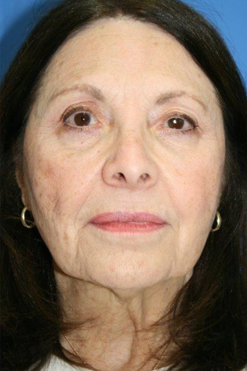 Neck Lift Before & After Gallery - Patient 250463 - Image 1