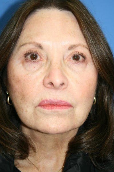 Deep Plane Facelift Before & After Gallery - Patient 245782 - Image 2