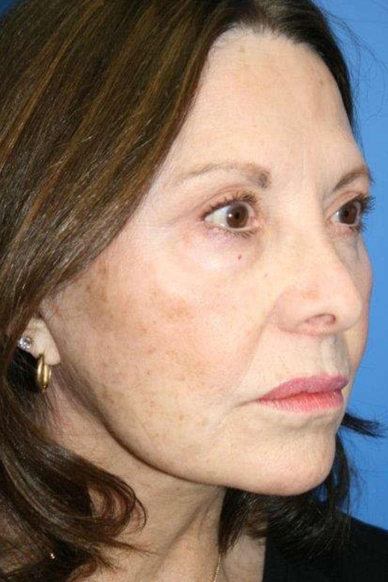 Neck Lift Before & After Gallery - Patient 250463 - Image 4