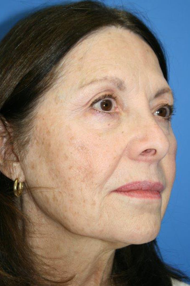 Neck Lift Before & After Gallery - Patient 250463 - Image 3