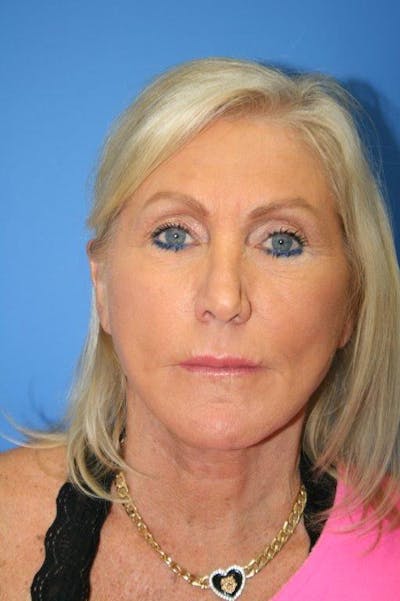 Deep Plane Facelift Before & After Gallery - Patient 423900 - Image 2