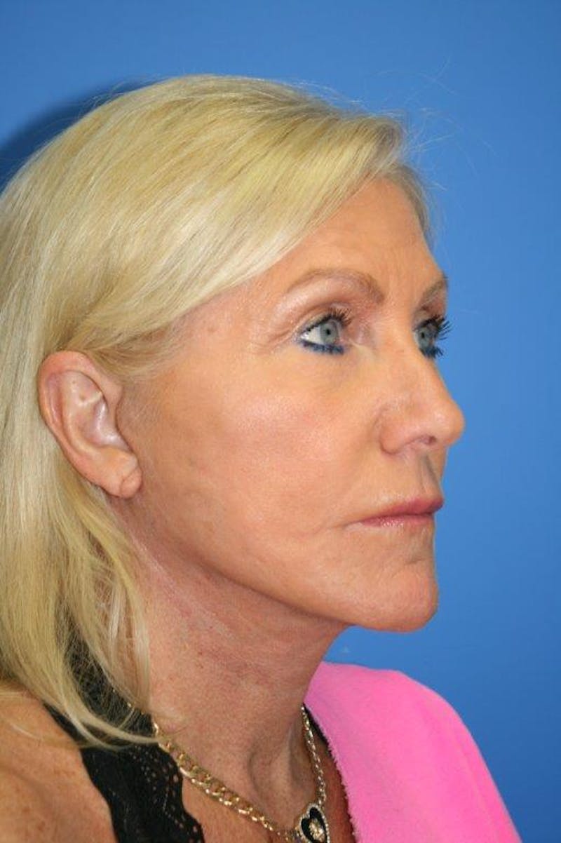 Neck Lift Before & After Gallery - Patient 174955 - Image 4