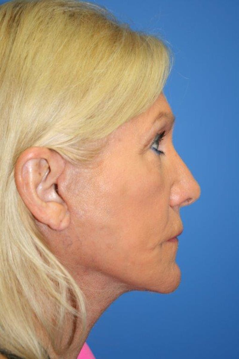 Neck Lift Before & After Gallery - Patient 174955 - Image 6