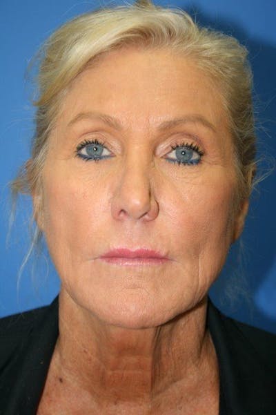 Deep Plane Facelift Before & After Gallery - Patient 423900 - Image 1