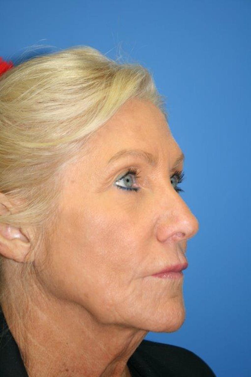 Neck Lift Before & After Gallery - Patient 174955 - Image 3