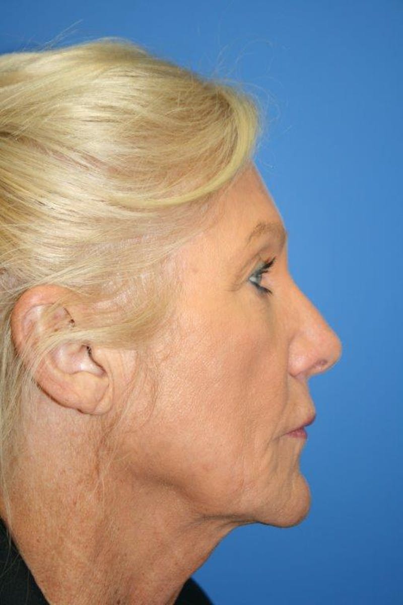 Neck Lift Before & After Gallery - Patient 174955 - Image 5