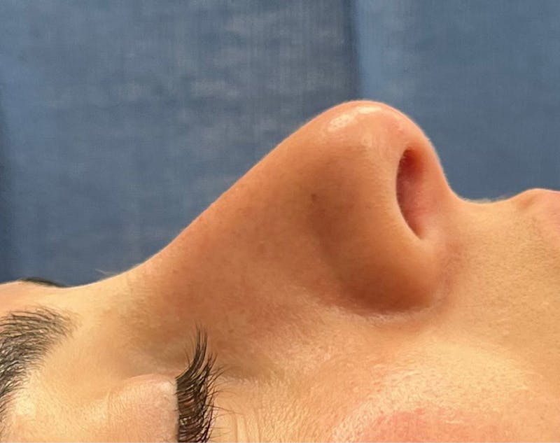 Rhinoplasty Before & After Gallery - Patient 377606 - Image 1
