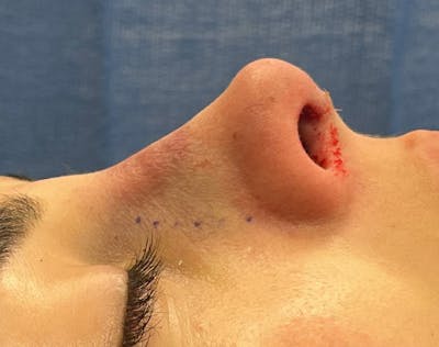 Rhinoplasty Before & After Gallery - Patient 377606 - Image 2