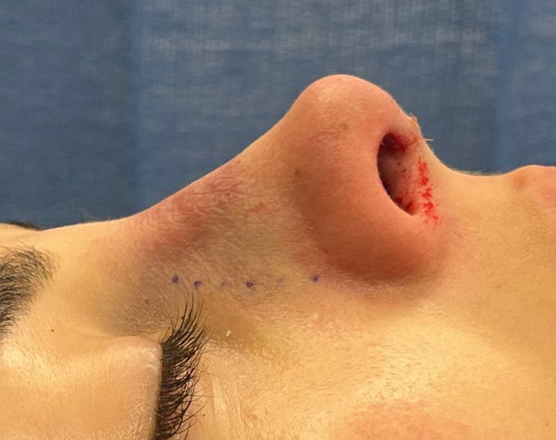 Rhinoplasty Before & After Gallery - Patient 377606 - Image 2