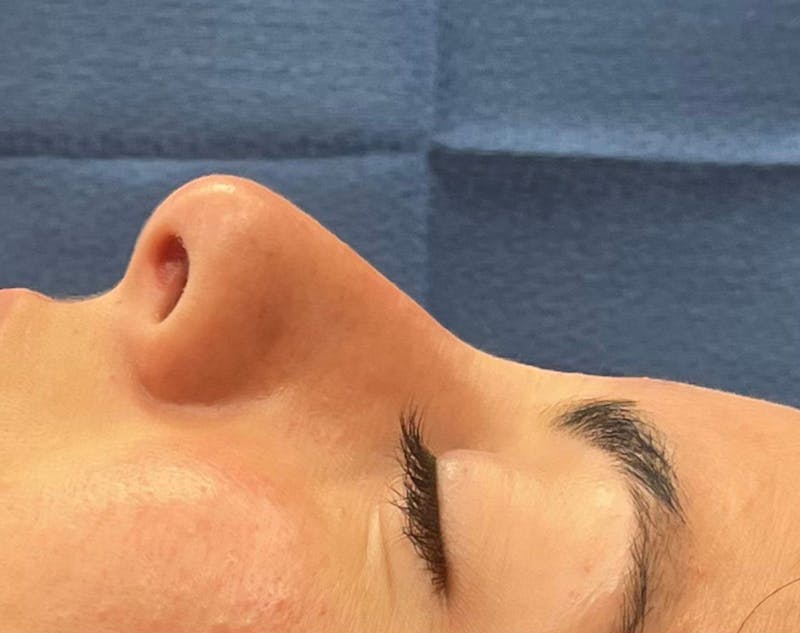 Rhinoplasty Before & After Gallery - Patient 377606 - Image 3