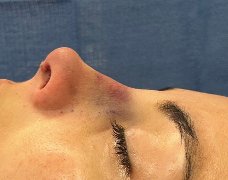 Rhinoplasty Before & After Gallery - Patient 377606 - Image 4