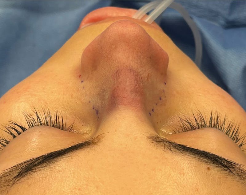 Rhinoplasty Before & After Gallery - Patient 377606 - Image 8