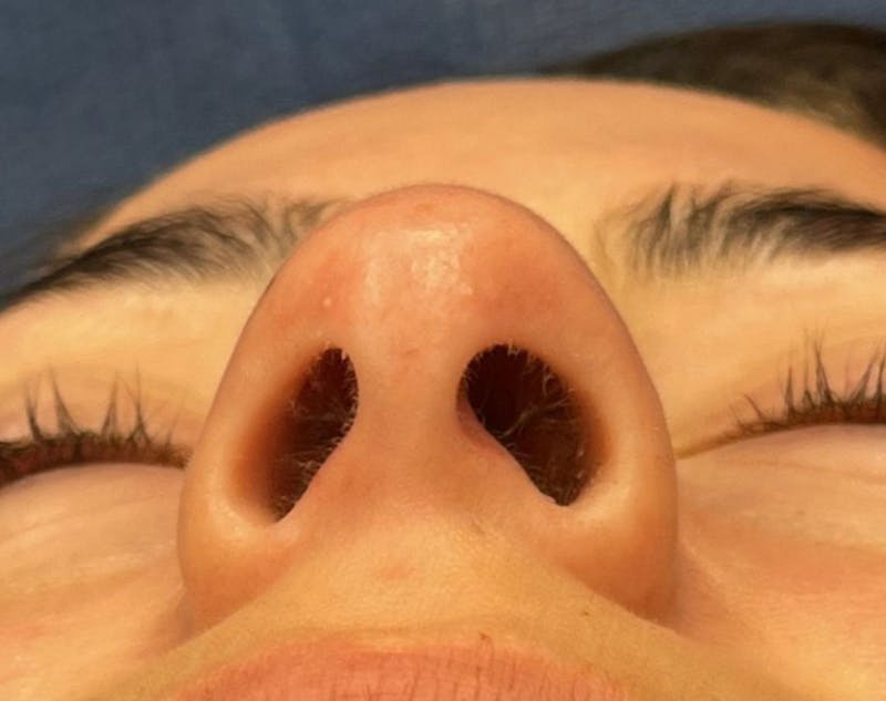 Rhinoplasty Before & After Gallery - Patient 377606 - Image 5