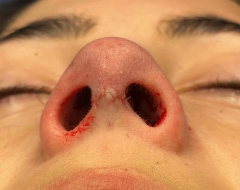 Rhinoplasty Before & After Gallery - Patient 377606 - Image 6
