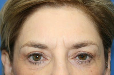 Brow Lift / Forehead Lift Before & After Gallery - Patient 134146 - Image 1
