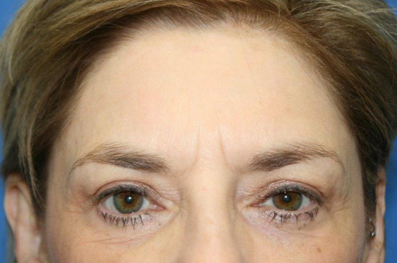 Brow Lift / Forehead Lift Before & After Gallery - Patient 134146 - Image 1