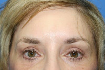 Brow Lift / Forehead Lift Before & After Gallery - Patient 134146 - Image 2
