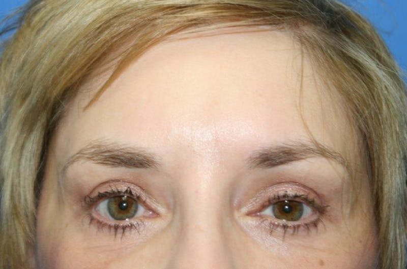 Brow Lift / Forehead Lift Before & After Gallery - Patient 134146 - Image 2