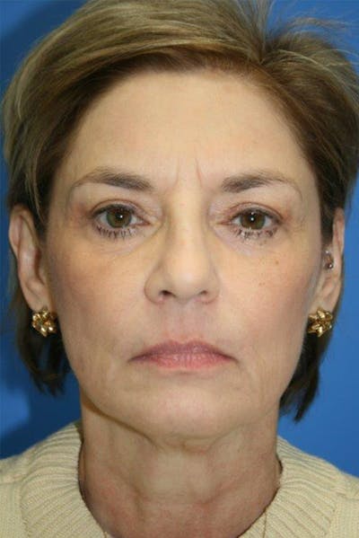 Deep Plane Facelift Before & After Gallery - Patient 311718 - Image 1