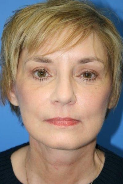 Deep Plane Facelift Before & After Gallery - Patient 311718 - Image 2
